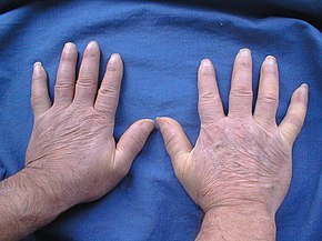 Scleroderma pictures Scleroderma antibodies Morphea scleroderma